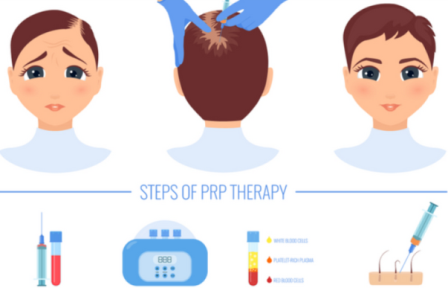 Plasma as a Graft Holding Solution for Hair Transplant